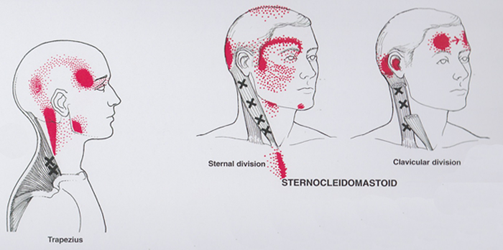 triggerpoint 2.png triggerpoint 2.png